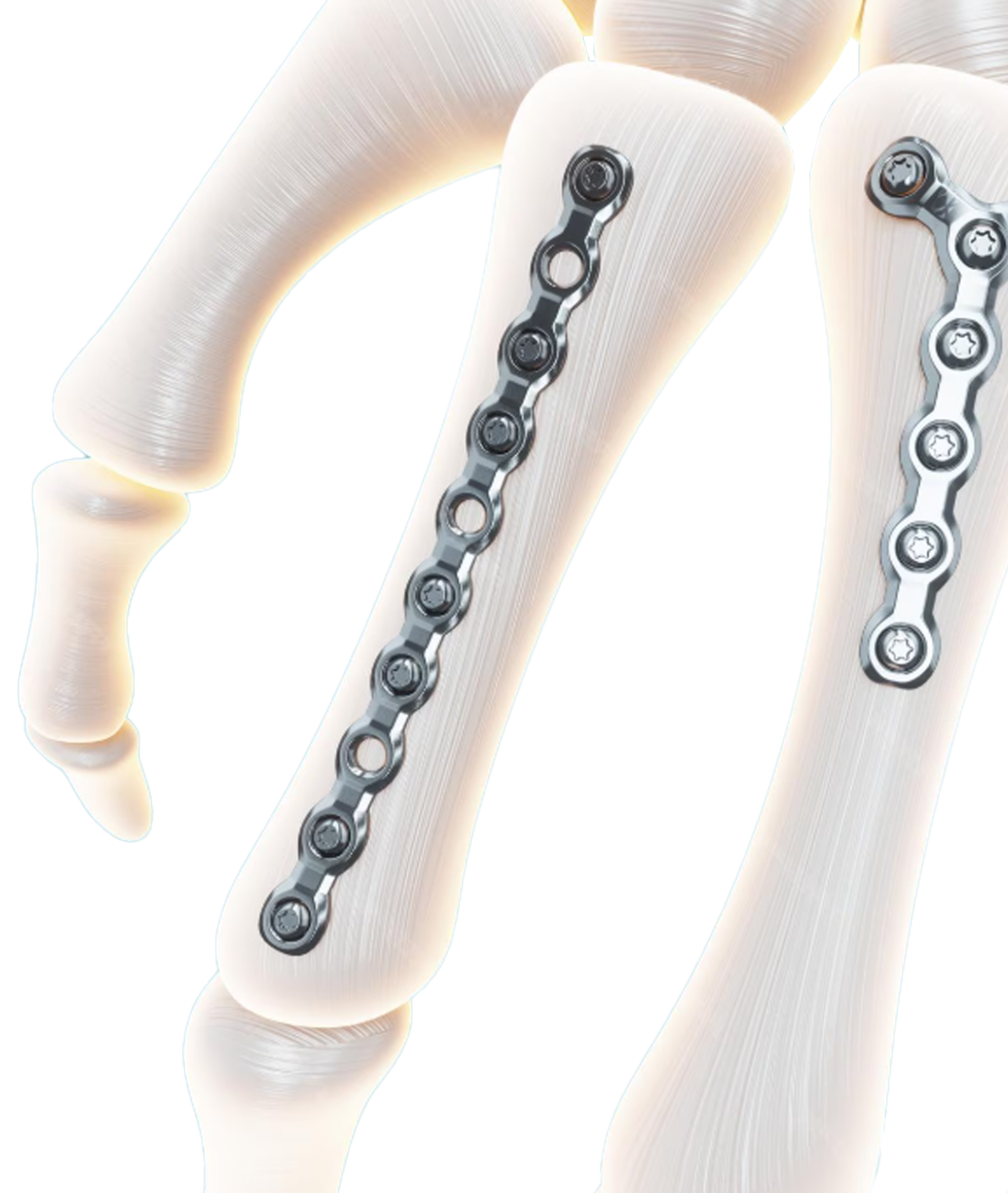 Bone Implant